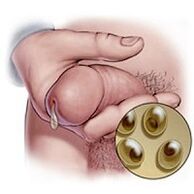 chlamydia shedding