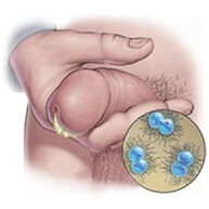 discharge from gonorrhea